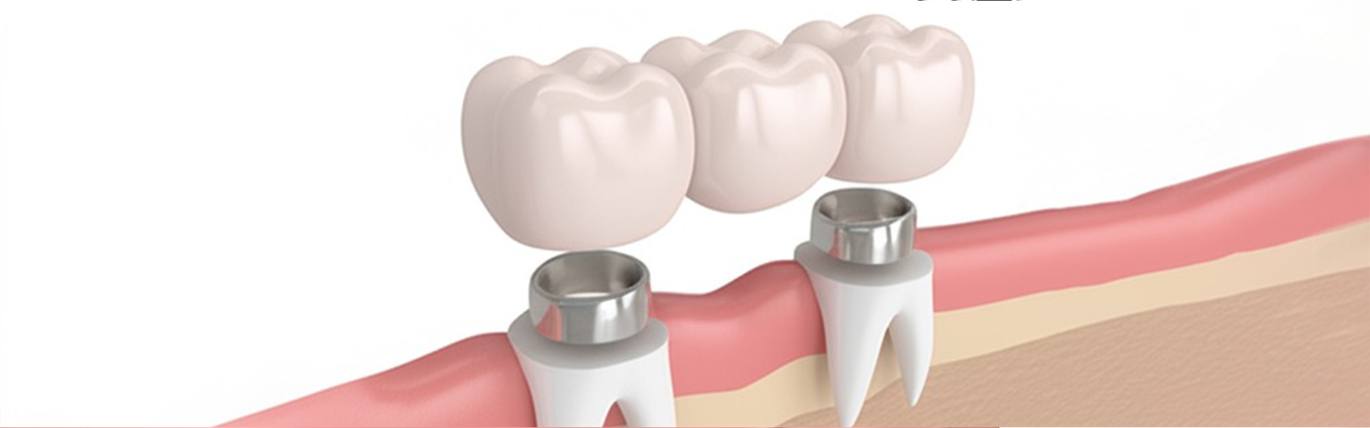 What Are White Zirconia Crowns